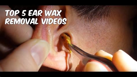 satisfying ear wax removal|very latest earwax removal video's.